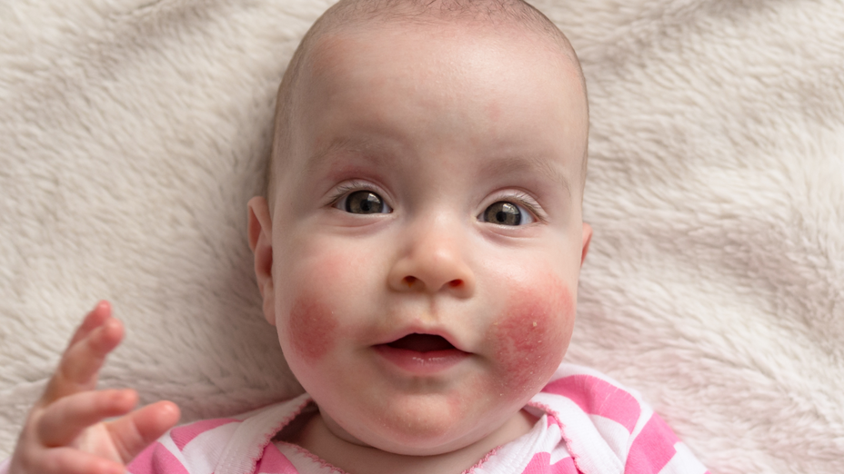 Autumn baby skin care: understanding and treating common issues